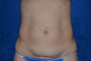Tummy-Tuck-Case-3734 | Before Tummy Tuck