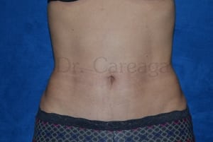 Tummy-Tuck-Case-3734 | After Tummy Tuck