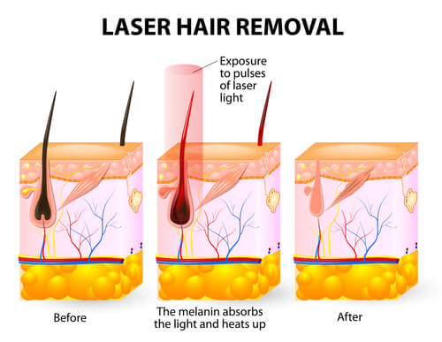 What to Expect From Laser Hair Removal Treatment