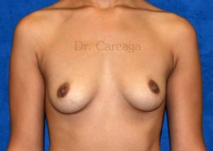 Breast-Augmentation-Case-3819 | Before Breast Augmentation