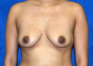 Breast-Augmentation--Case-3841 | Before Breast Augmentation