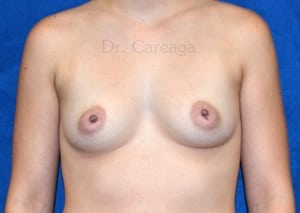 Breast-Augmentation-Case-3852 | Before Breast Augmentation