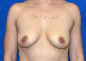 Breast-Augmentation-Case-3863 | Before Breast Augmentation