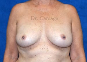Breast-Augmentation-Case-3907 | Before Breast Augmentation