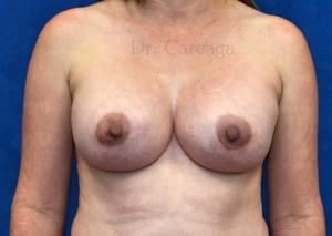 Breast-Augmentation-Case-3918 | After Breast Augmentation