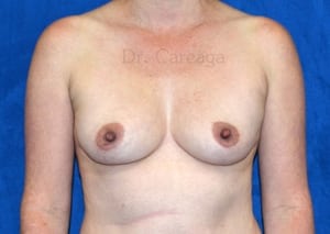 Breast-Augmentation-Case-3918 | Before Breast Augmentation