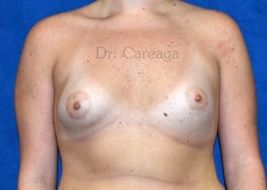 Breast-Augmentation-Case-3929 | Before Breast Augmentation
