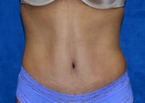 Tummy-Tuck-Case-4027 | After Tummy Tuck