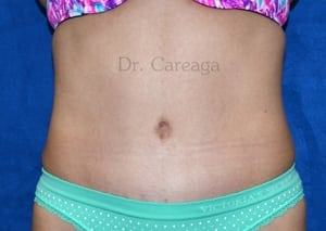 Tummy-Tuck-Case-4038 | After Tummy Tuck