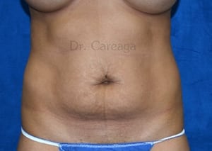 Tummy-Tuck-Case-4049 | Before Tummy Tuck