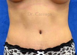 Tummy-Tuck-Case-4049 | After Tummy Tuck