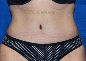 Tummy-Tuck-Case-4060 | After Tummy Tuck