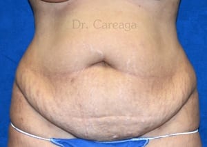 Tummy-Tuck-Case-4060 | Before Tummy Tuck