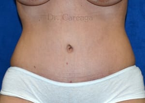 Tummy-Tuck-Case-4071 | After Tummy Tuck