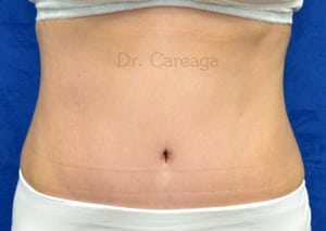 Tummy-Tuck-Case-4093 | After Tummy Tuck