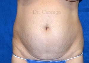 Tummy-Tuck-Case-4093 | Before Tummy Tuck