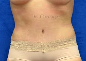 Tummy-Tuck-Case-4104 | After Tummy Tuck