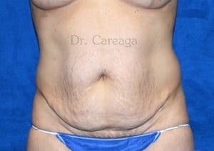 Tummy-Tuck-Case-4104 | Before Tummy Tuck