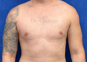Gynecomastia-Case-4159 | After Gynecomastia