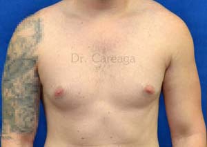 Gynecomastia-Case-4159 | Before Gynecomastia