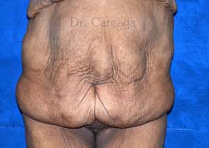 Massive-Weight-Loss-Case-4170 | Before Massive Weight Loss