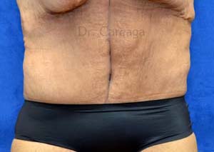 Massive-Weight-Loss-Case-4170 | After Massive Weight Loss