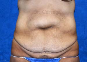 Massive-Weight-Loss-Case-4181 | Before Massive Weight Loss