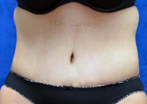 Massive-Weight-Loss-Case-4181 | After Massive Weight Loss