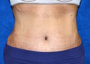 Massive-Weight-Loss-Case-4192 | After Massive Weight Loss