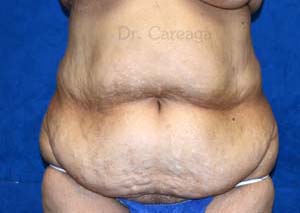 Massive-Weight-Loss-Case-4192 | Before Massive Weight Loss