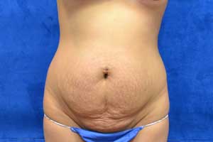 Tummy-Tuck-Case-5092 | Before Tummy Tuck