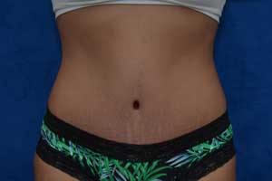 Tummy-Tuck-Case-5092 | After Tummy Tuck