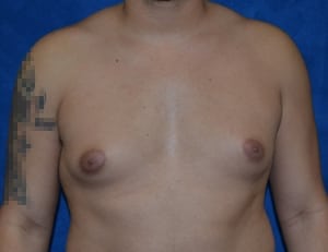 Gynecomastia-Case-4957 | Before Gynecomastia