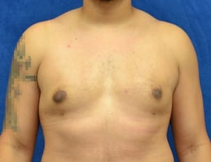 Gynecomastia-Case-4957 | After Gynecomastia