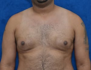 Gynecomastia-Case-4969 | Before Gynecomastia