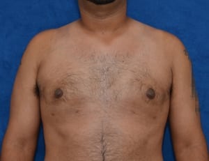 Gynecomastia-Case-4969 | After Gynecomastia