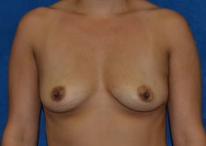 Breast-Augmentation-Case-5392 | Before Breast Augmentation