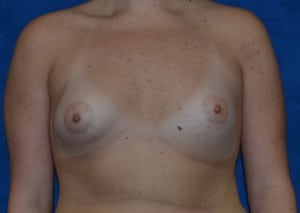 Breast-Augmentation-Case-5404 | Before Breast Augmentation
