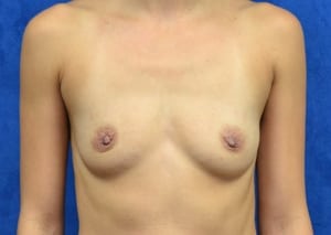 Breast-Augmentation-Case-5476 | Before Breast Augmentation