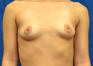 Breast-Augmentation-Case-5500 | Before Breast Augmentation