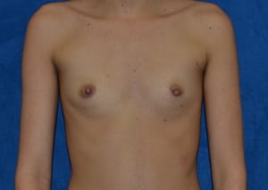 Breast-Augmentation-Case-5512 | Before Breast Augmentation