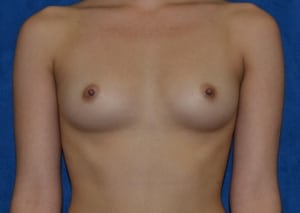 Breast-Augmentation-Case-5512---8211--2 | Before Breast Augmentation