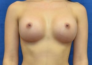 Breast-Augmentation-Case-5512---8211--2 | After Breast Augmentation
