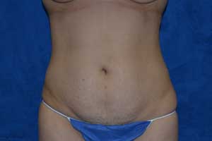 Tummy-Tuck-Case-5128 | Before Tummy Tuck