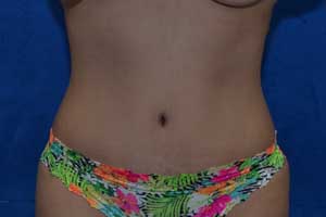 Tummy-Tuck-Case-5128 | After Tummy Tuck