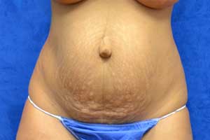 Tummy-Tuck-Case-5140 | Before Tummy Tuck