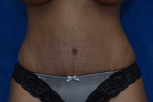 Tummy-Tuck-Case-5140 | After Tummy Tuck