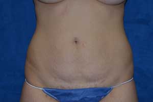 Tummy-Tuck-Case-5152 | Before Tummy Tuck
