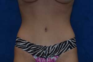 Tummy-Tuck-Case-5152 | After Tummy Tuck