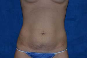 Tummy-Tuck-Case-5164 | Before Tummy Tuck